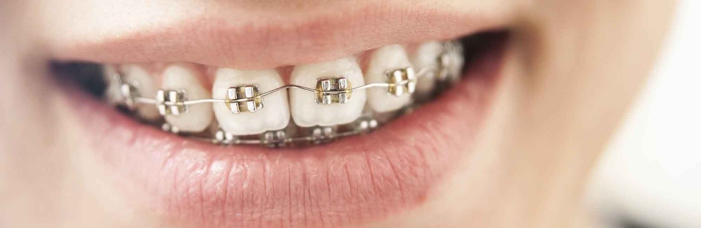 Smiling child with braces